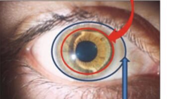 piggybank contact lens