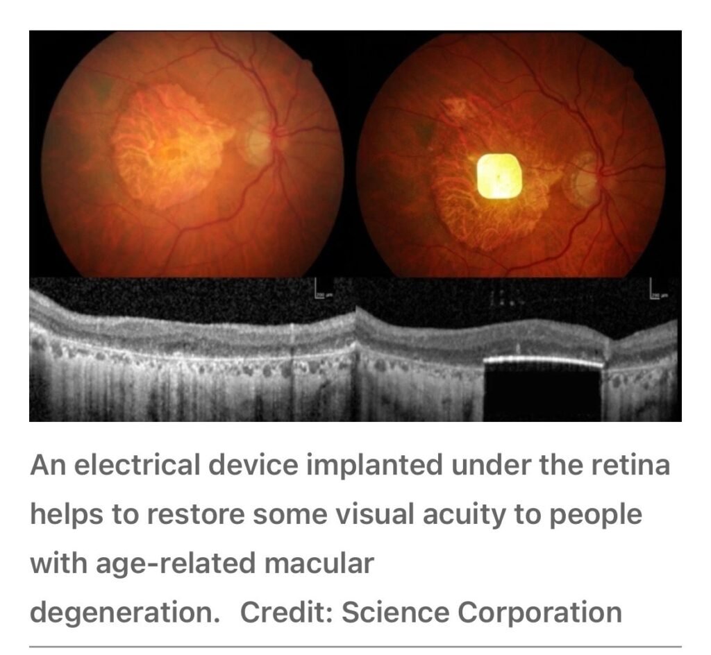 Breakthrough in Vision Restoration: The PRIMA Bionic Chip Lets Blind Patients Read Again