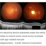 Breakthrough in Vision Restoration: The PRIMA Bionic Chip Lets Blind Patients Read Again