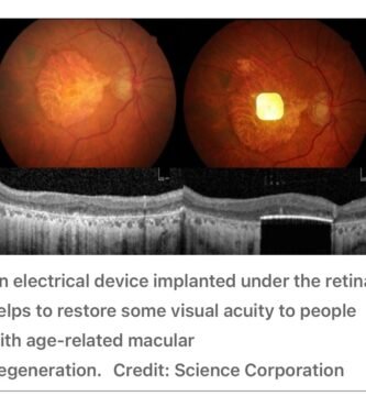 Breakthrough in Vision Restoration: The PRIMA Bionic Chip Lets Blind Patients Read Again