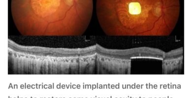Breakthrough in Vision Restoration: The PRIMA Bionic Chip Lets Blind Patients Read Again