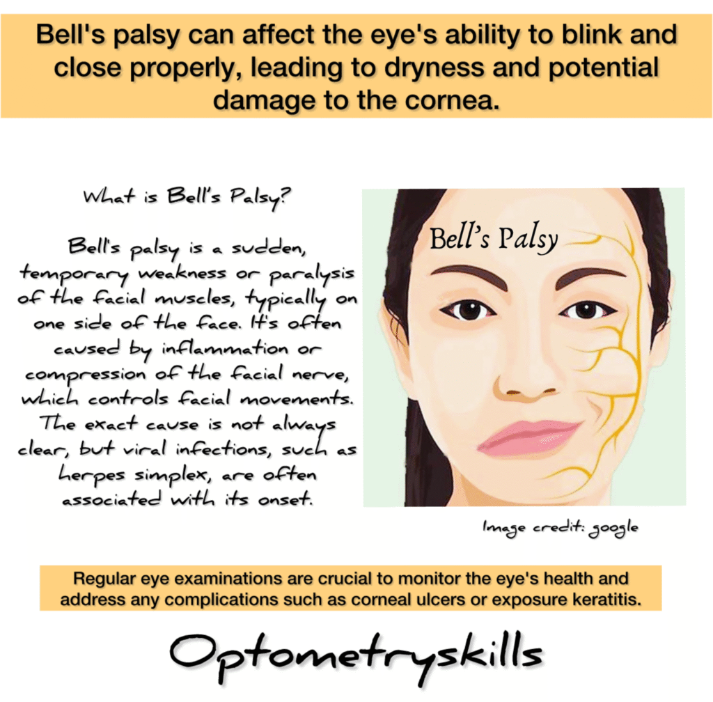 Bell's palsy Awareness Poster