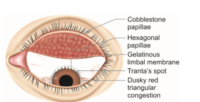 Vernal Keratoconjunctivitis