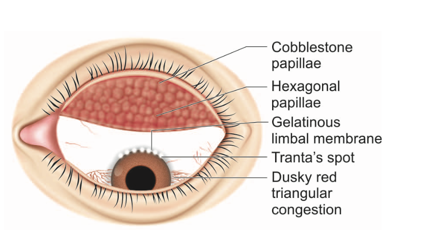 Vernal Keratoconjunctivitis