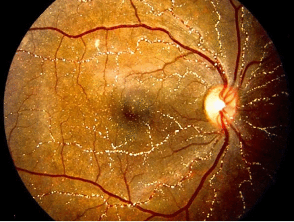 Methoxyflurane-Induced Crystalline Retinopathy
