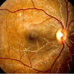 Methoxyflurane-Induced Crystalline Retinopathy