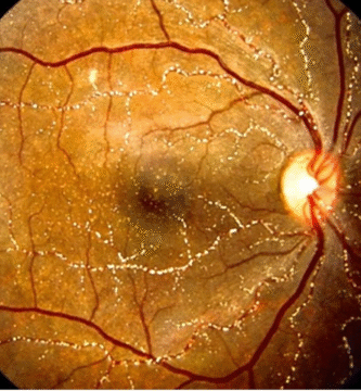 Methoxyflurane-Induced Crystalline Retinopathy
