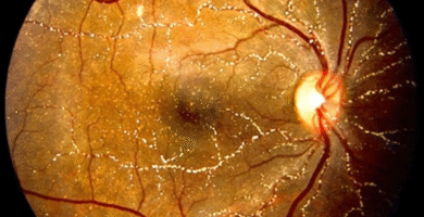 Methoxyflurane-Induced Crystalline Retinopathy