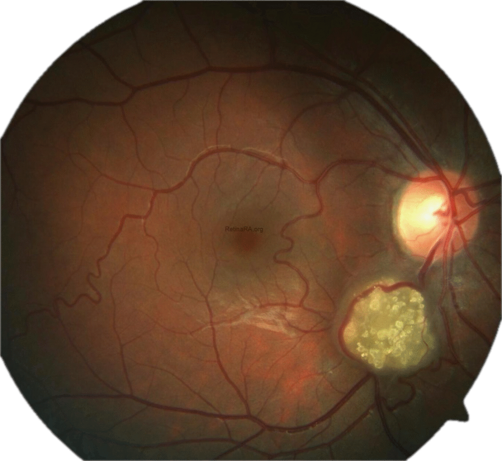 Retinal Astrocytoma (Retinal Astrocytic Hamartoma)