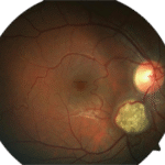 Retinal Astrocytoma (Retinal Astrocytic Hamartoma)