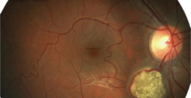 Retinal Astrocytoma (Retinal Astrocytic Hamartoma)