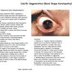 Notes on Band shaped Keratopathy