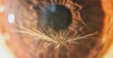 Vortex Keratopathy