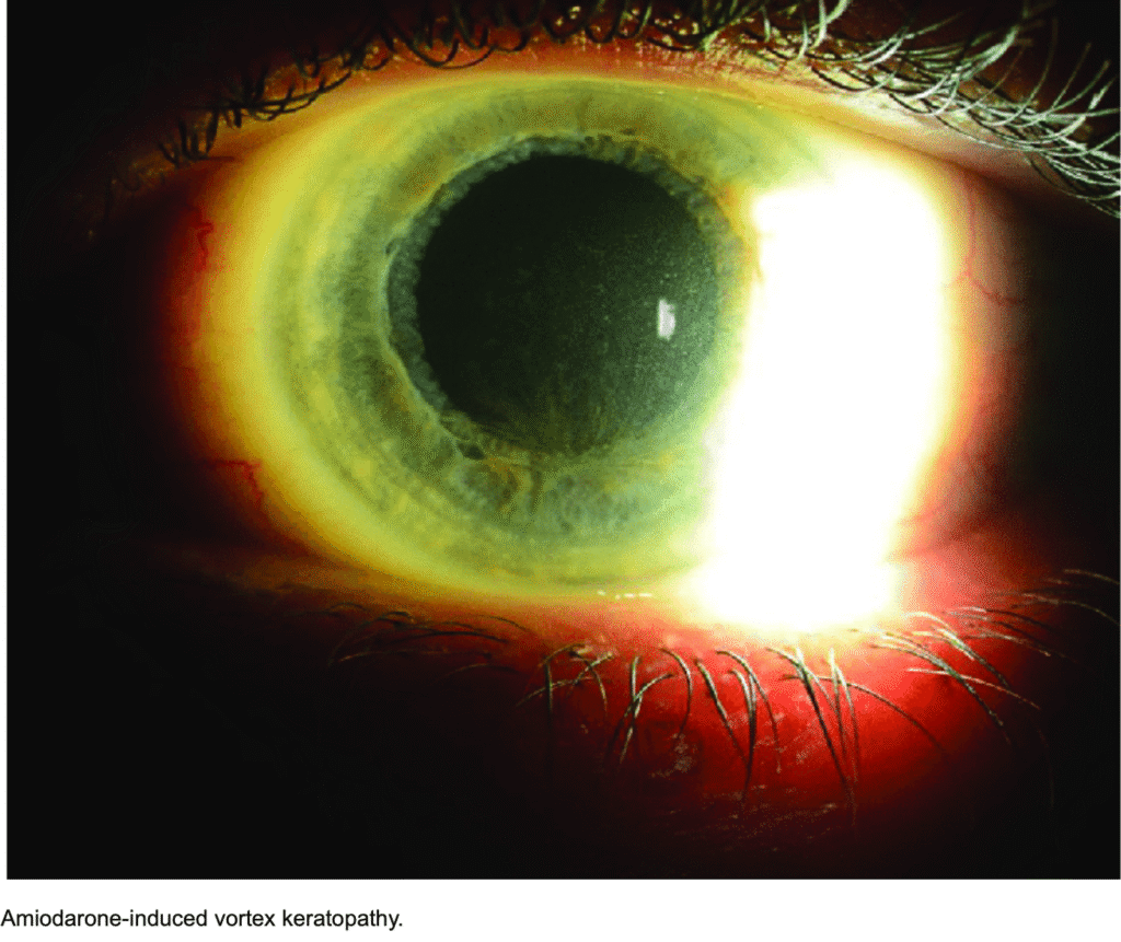 Vortex Keratopathy