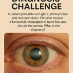 Calcific Band Keratopathy