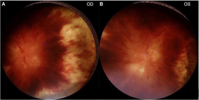 CU portable fundus photography camera