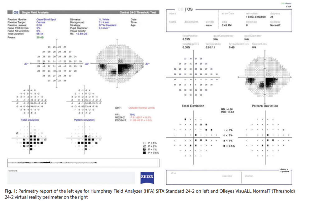 Mastering Automated Perimetry: Essential Tips and Tricks for Optometrists