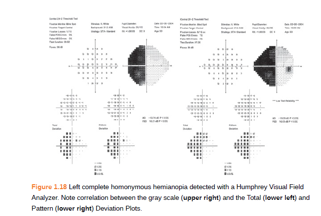 Five-Step Approach to Visual Field Interpretation