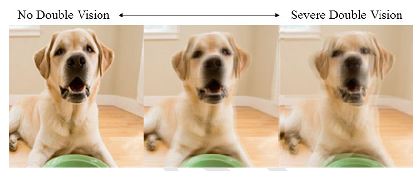 Risk of LASIK double vision