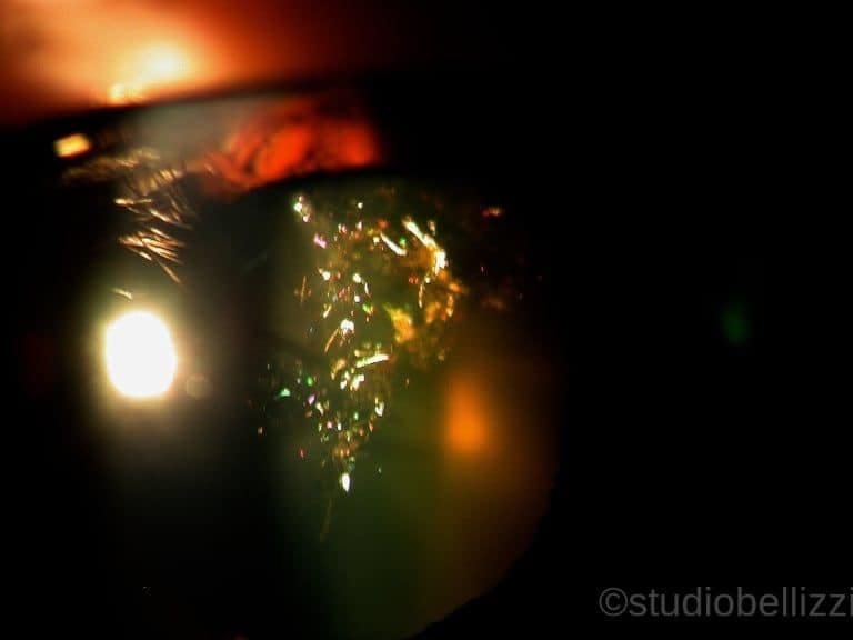 Christmas Tree Cataract