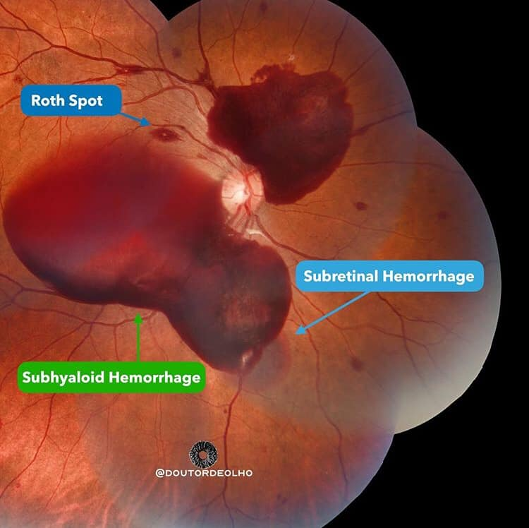 Types of Retinal Hemorrhages and its treatment. 3 Types of Retinal Hemorrhages and its treatment