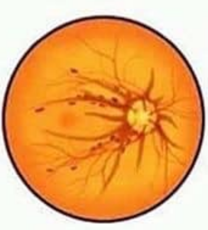 Types of Retinal Hemorrhages and its treatment. 4 Types of Retinal Hemorrhages and its treatment