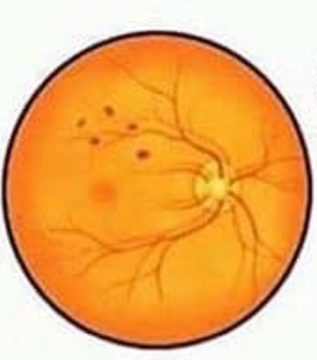 Types of Retinal Hemorrhages and its treatment. 5 image 35