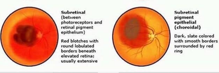 Types of Retinal Hemorrhages and its treatment. 6 image 36