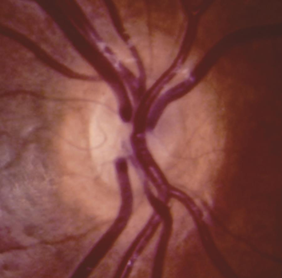 Optic Disc Abnormalities ONH