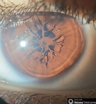Persistent Pupillary Membrane