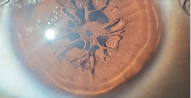 Persistent Pupillary Membrane