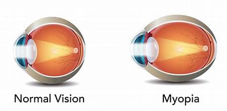 myopia