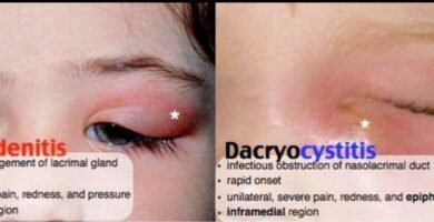 Dacryocystitis vs Dacryoadenitis: