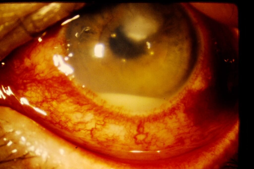 Hypopyon Corneal ulcer