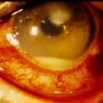 Hypopyon Corneal ulcer