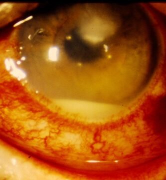 Hypopyon Corneal ulcer