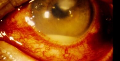 Hypopyon Corneal ulcer