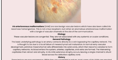 Iris Arteriovenous Malformation