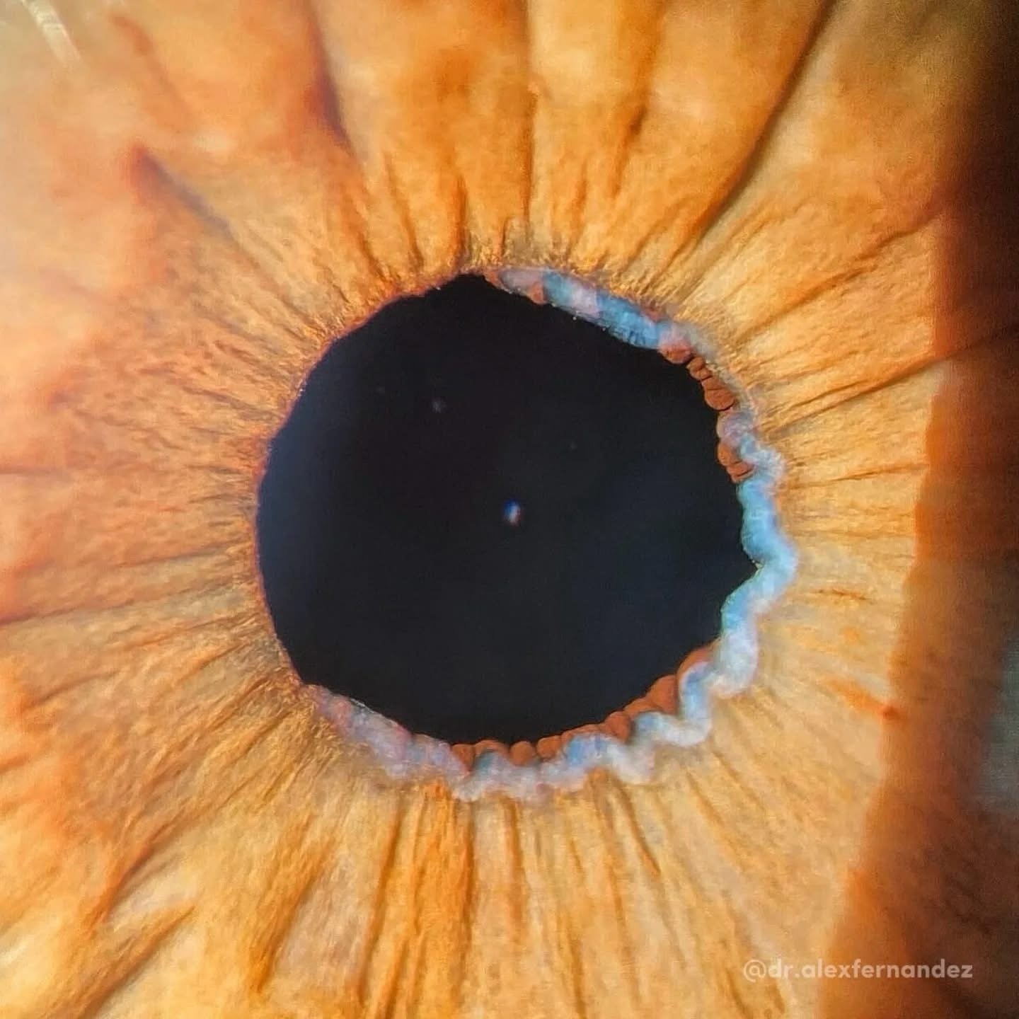 What Is Pseudoexfoliation Syndrome (PEX)? - Optometryskills