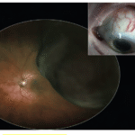 Choroidal Melanoma