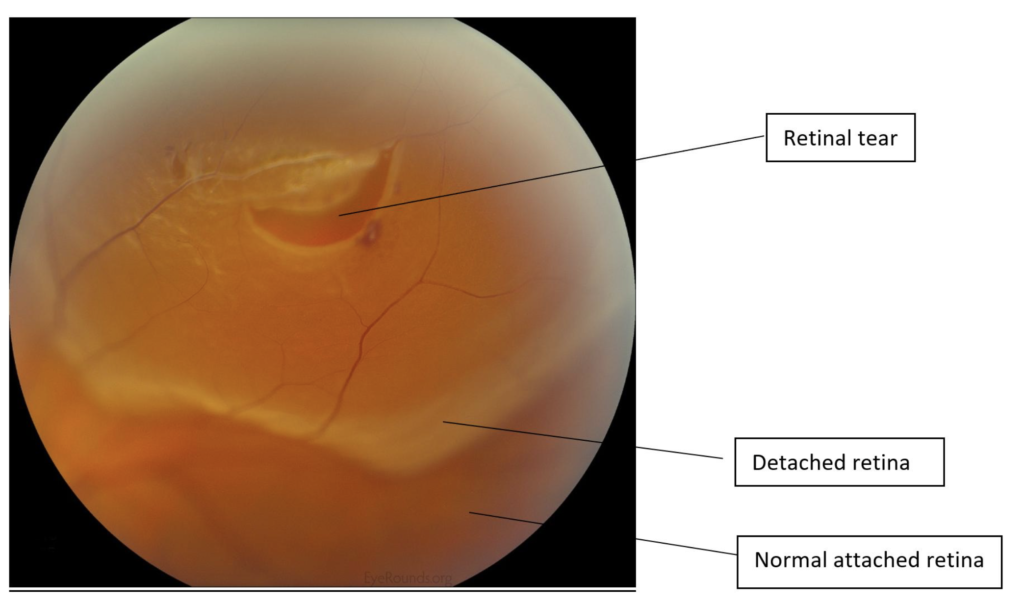Horseshoe Retinal Tear: