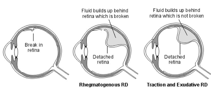 Horseshoe Retinal Tear: