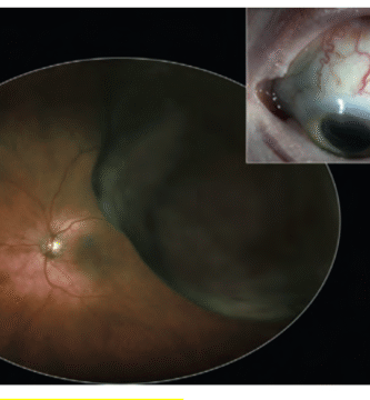 Choroidal Melanoma