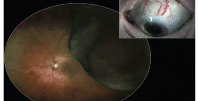 Choroidal Melanoma