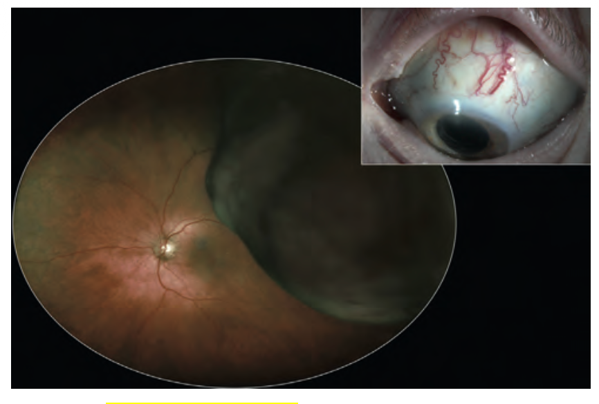 Choroidal Melanoma