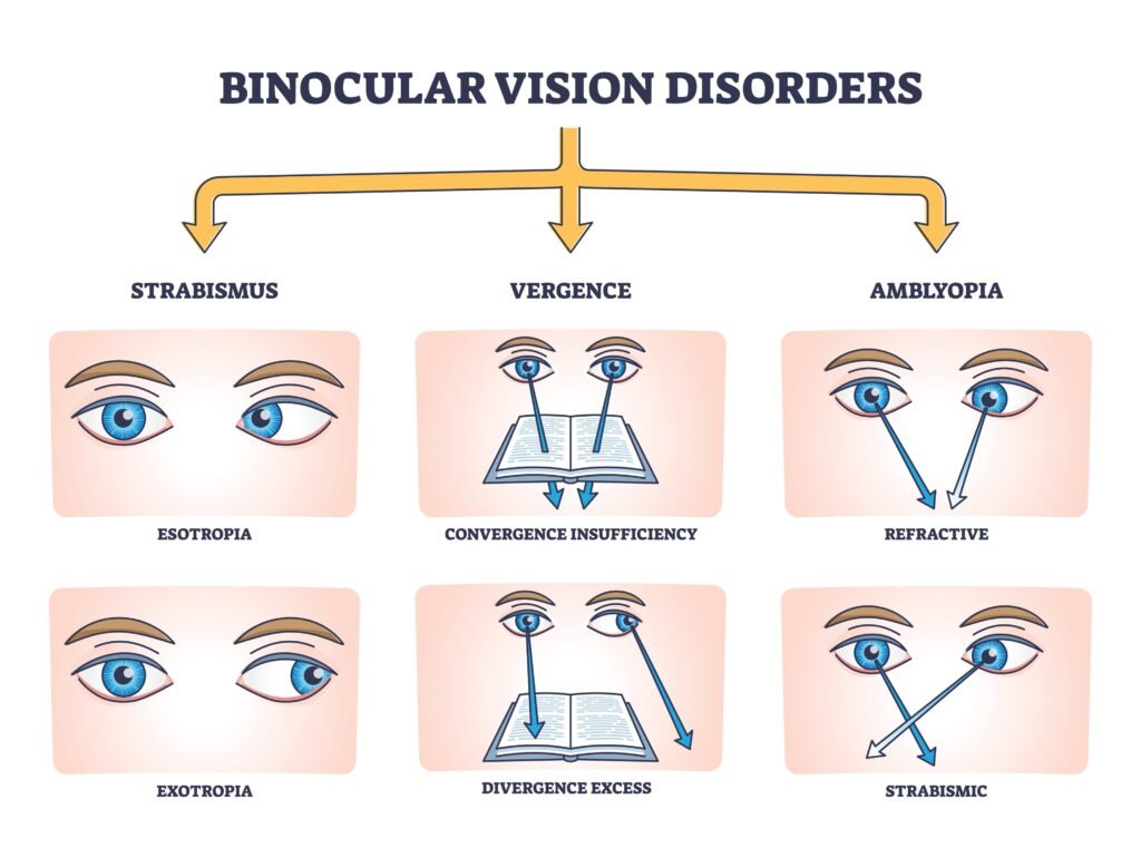 Binocular Vision Disorder, BVD