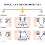 Binocular Vision Disorder, BVD
