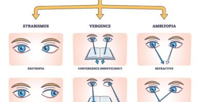 Binocular Vision Disorder, BVD